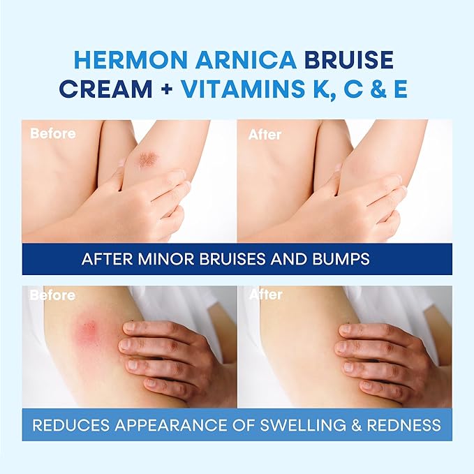 Hermon Arnica Bruise Cream: Reduce Bruising & Swelling on Thin Skin - Arnica Montana with Vitamins K, C & E–Hydrating Moisturizer for Face 4 oz