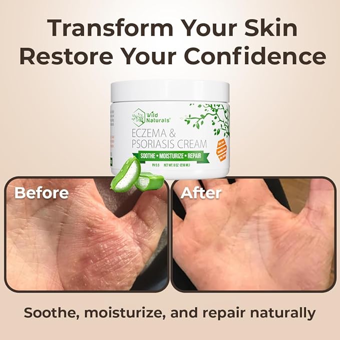 Wild Naturals Eczema & Psoriasis Cream for Dry, Itchy Skin + Moisturizing Eczema Body Wash – Gentle Psoriasis Body Wash for Itchy, Dry Skin Relief