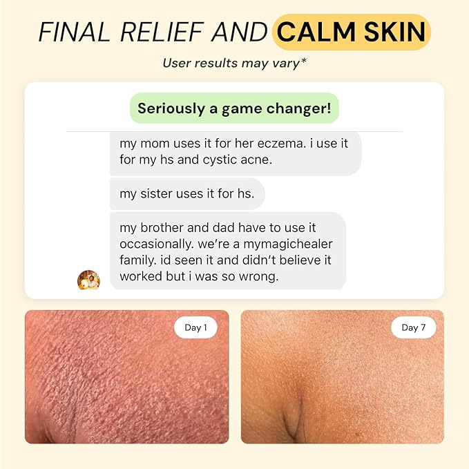 MyMagicHealer Universal Flare Care | Essential Oil Free | Relief for Rashes, Eczema, Psoriasis, Hidradenitis Suppurativa, Impetigo, Dermatitis, Wound Care, Sensitive Skin w/Propolis & Egg Yolk 1 oz