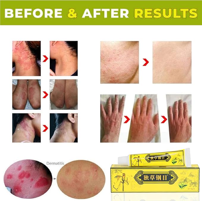 5Pcs Chinese Herbal Eczema Psoriasis Creams Dermatitis and Eczema Pruritus Psoriasis Ointment