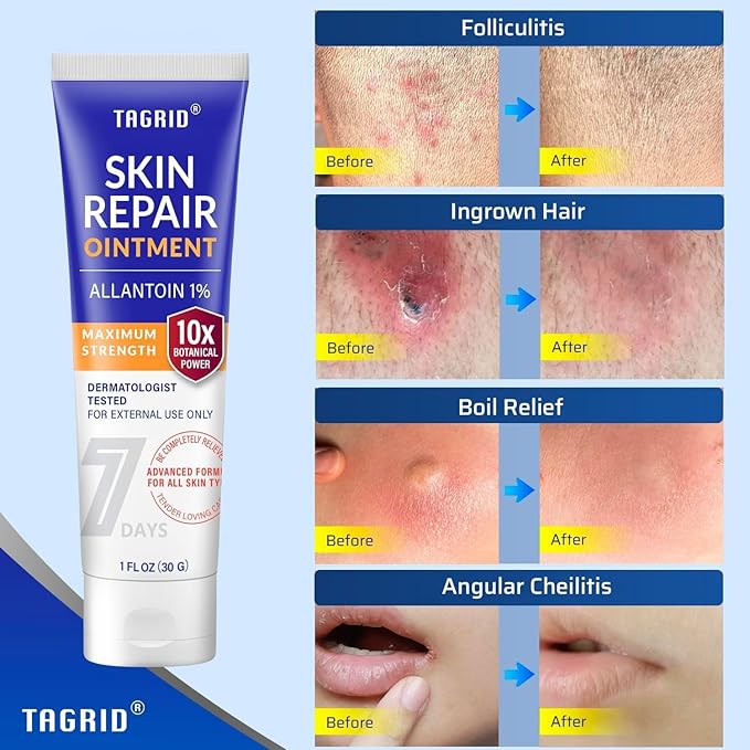 TAGRID Skin Repair Ointment (1 Fl Oz) for Ingrown Hair, Folliculitis, Boils, Angular Cheilitis, Lichen Sclerosis, Impetigo, and Pitted Keratolysis Treatment - Maximum Strength Antifungal Cream