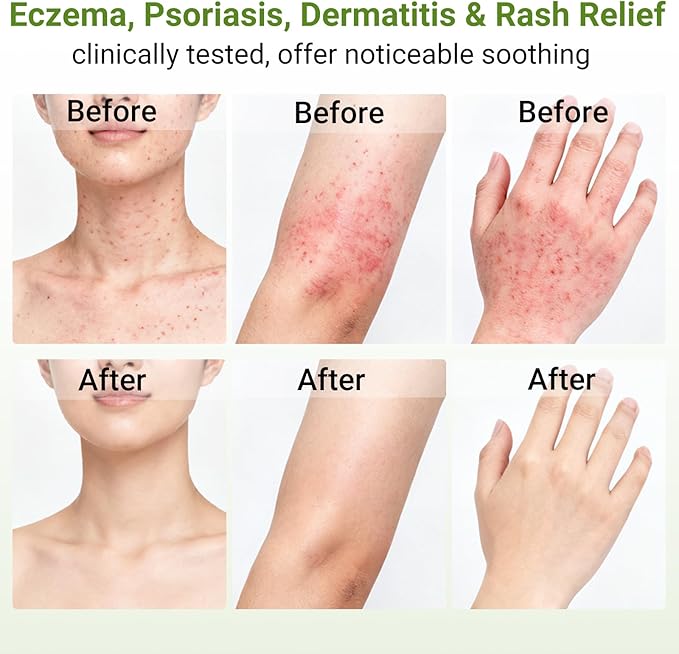 Eczema Cream, Psoriasis, Dermatitis & Rashes Treatment, Moisturizer for Dry, Itchy & Sensitive Skin, Face, Scalp & Body Soothing, Eczema Relief for Kids & Adults, 3.53 OZ