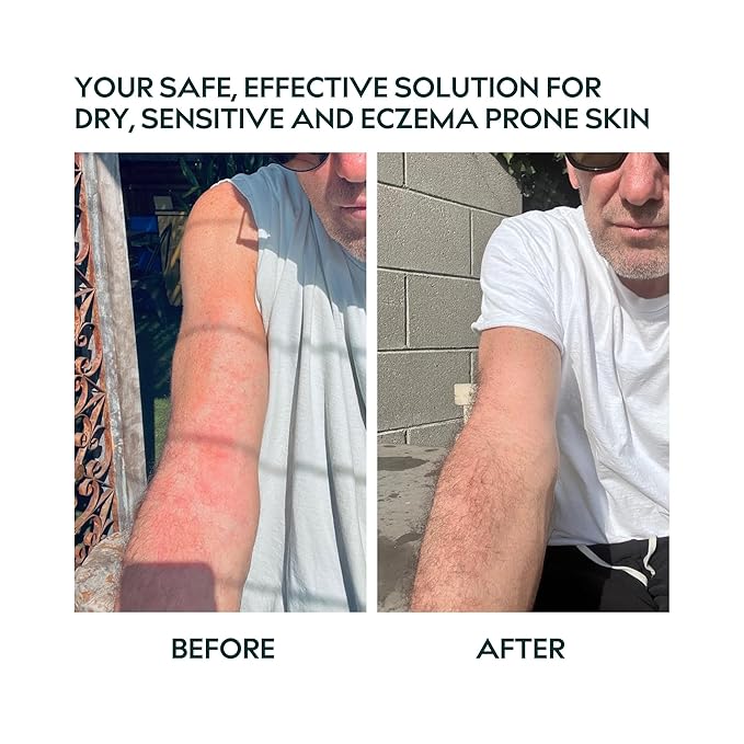 Herbitual Eczema Relief Balm – Soothing Moisturizer for Face & Body, Dry & Sensitive Skin Barrier Protectant Cream, Flare-Up Treatment for Itchy, Irritated Skin, Steroid & Fragrance-Free