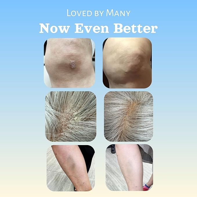 Natural SKIN REPAIR. Clinically tested Aromatherapy. Powerful Essential Oil. Eczema, Dermatitis, Diaper rash, and Sensitive skin. For all skin types. Hypoallergenic, Vegan, Paraben Free. 30ML TUBE