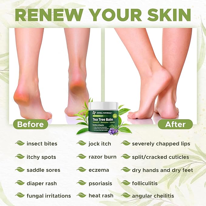 OWELL NATURALS Tea Tree Antifungal Balm – Soothing & Fast-Acting Relief for Athlete’s Foot, Jock Itch, Dry Cracked Skin, and Rashes – Natural Healing Ointment for Feet & Body, 2 oz (2 Pack)