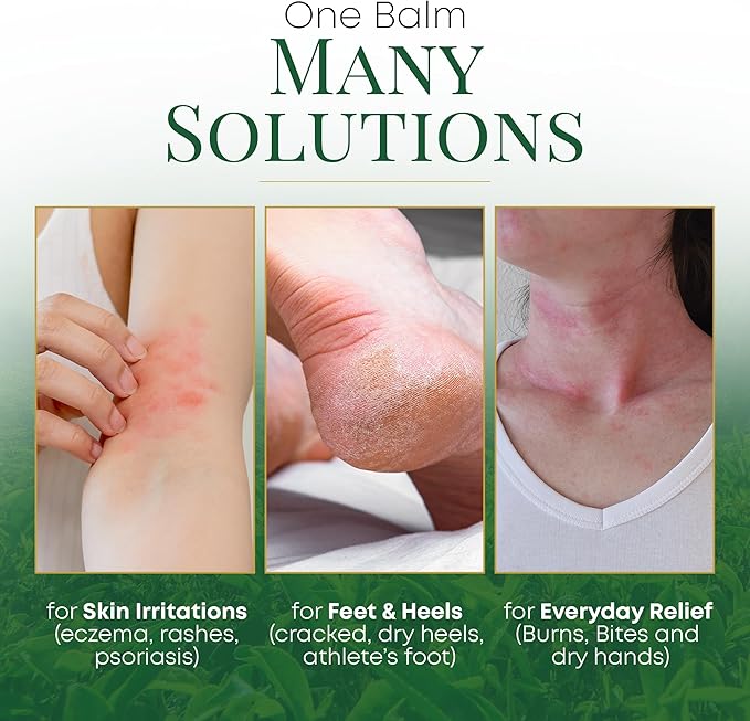 Chamuel Tea Tree Oil Balm - All Natural | Great Cream for Soothing Eczema, Psoriasis, Rashes, Jock Itch, Insect Bites, Folliculitis, Acne, Itches, Cracked Heels, Cuticles, Saddle Sores & more!
