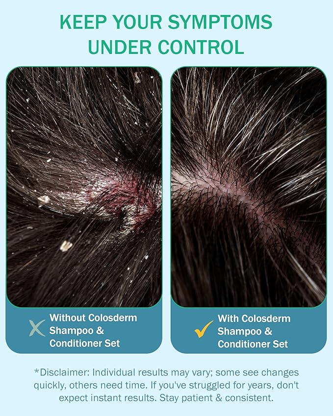 Eczema Cream Shampoo and Conditioner Scalp Treatment for Sensitive Skin for Kids & Adults- Colostrum & Colloidal Oatmeal -Itchy Scalp Anti Dandruff Shampoo for Women & Men, 16 fl oz, Made in USA